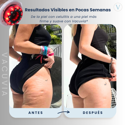 Vacuvia® SculptGlow™ - Piel más Firme y Tonificada